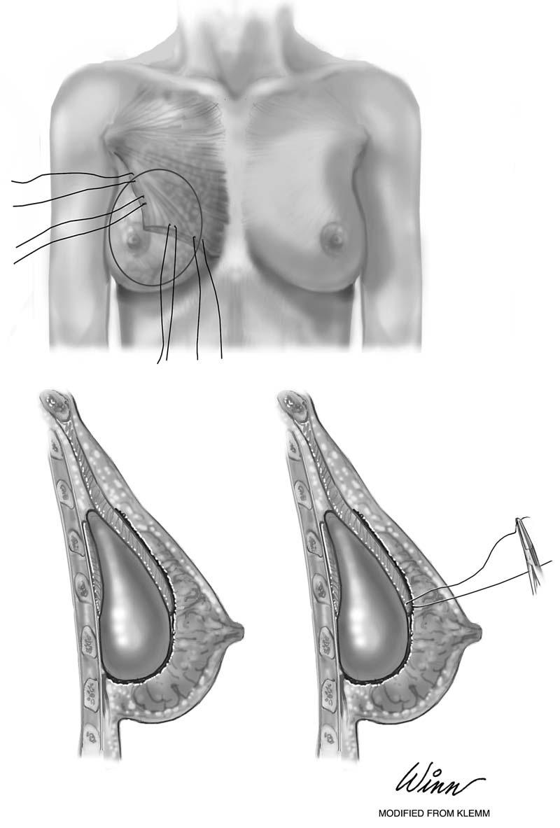 Figure 1. A, Implant in position with marionette sutures placed at the inferior edge of the pectoralis major muscle.
