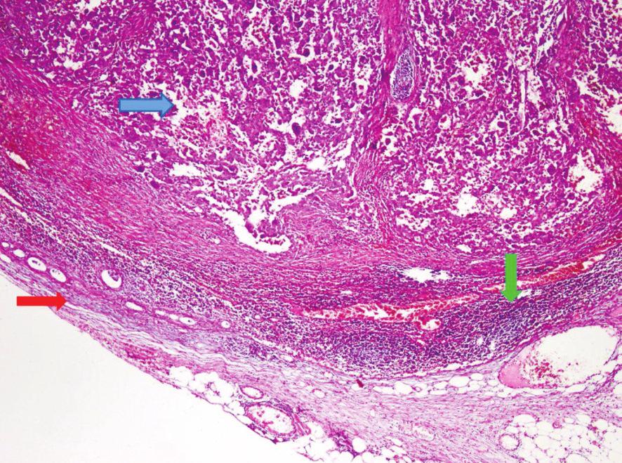 specimen otined from the lesion locted t left upper loe picoposterior segment supported mlignncy of primry lung (non-smll cell lung crcinom) (Figure 3, ).