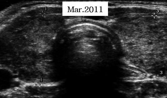 Won Sang Yoo Fig. 2. Thyroid ultrasonographic findings of painless thyroiditis episodes in the three cases.