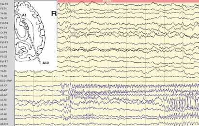 # Au et al # impinging on motor or speech function. Left frontal craniotomy for implantation of a subdural grid and inter-hemispheric strips was performed.