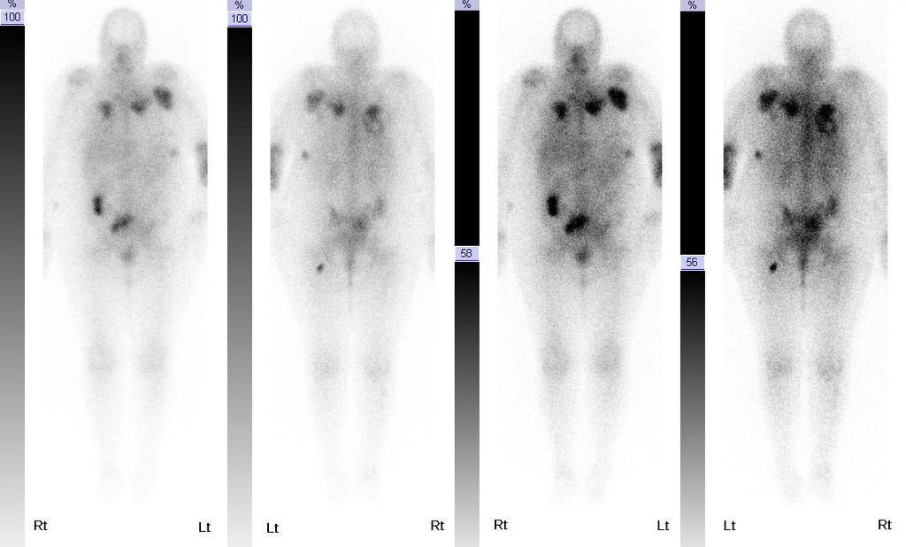 Gallium Imaging 68 year old female, oncology in-patient Known rhabdosarcoma