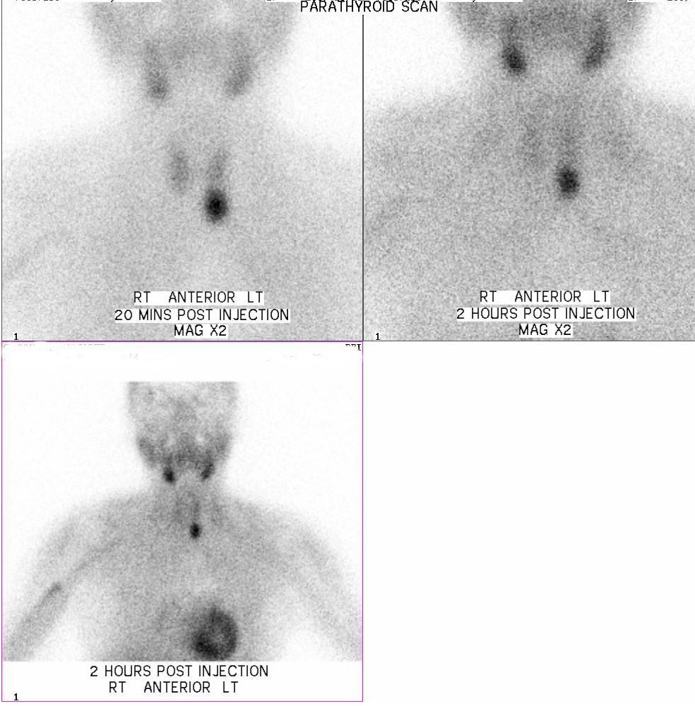 Parathyroid Imaging 67 year old lady awaiting mastectomy for breast cancer.