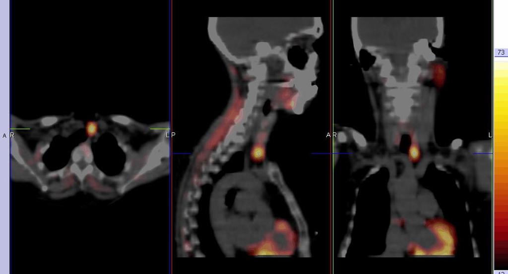 Parathyroid Imaging Single intense focus of activity