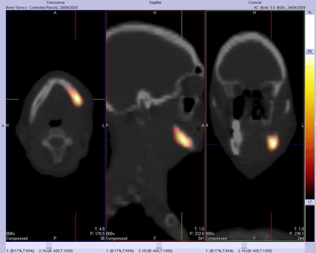 Skeletal Imaging SPECT/CT demonstrates