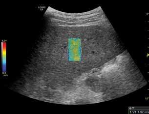 QUESTIONS ELASTOGRAPHY VOLUME ULTRASOUND ELASTOGRAPHY Gain more information for patient management Strain Elastography This robust tool, which includes mapping,