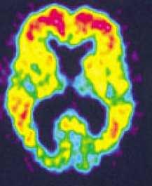Why do we undertake brain imaging in dementia?