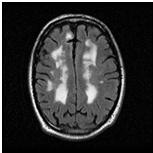 (FP-CIT) SPECT (for Lewy body dementia) Amyloid (florbetapir) PET NINDS Neuroimaging Criteria for VaD