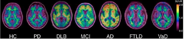 Amyloid imaging in Dementia Evidence-based indications for PET- CT: 18F-Florbetapir Use in highly selected patients where: Alzheimer s dementia