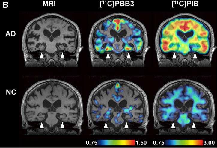hypometabolism on PET/SPECT Amyloid positive PET imaging Abnormal CSF biomarkers (reduced A beta 42, raised tau / p-tau) Clinical utility yet to