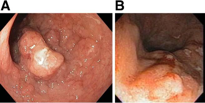 February 2010 AGA 757 Figure 3. (A and B) Endoscopic images of adenoma-like DALMs. Images provided courtesy of Jerome D. Waye, MD.