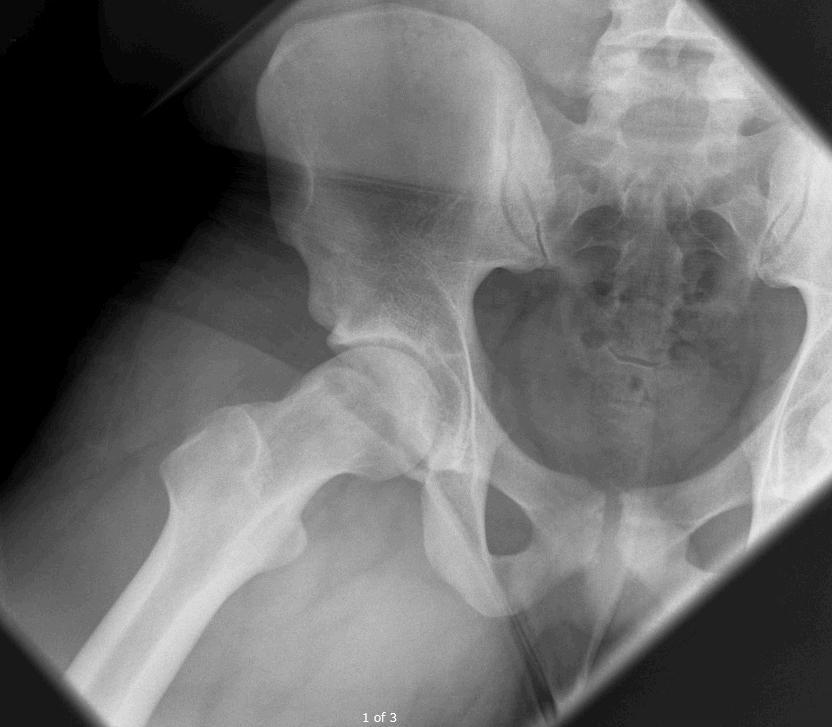 Background Femoroacetabular impingement (FAI) has become an increasingly recognized cause of hip pain 8,9 FAI - abnormal bony offset or overgrowth creates irregular mechanical motion between the