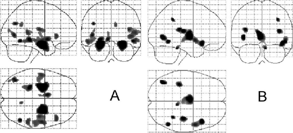 Patterns of atrophy in AD and DLB vs control AD DLB Bilateral: insula, and thalamus.