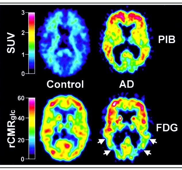 PET Imaging of Amyloid Deposits in Alzheimer s Disease vs Normal Controls PET imaging Pittsburgh Compound-B (PIB), can
