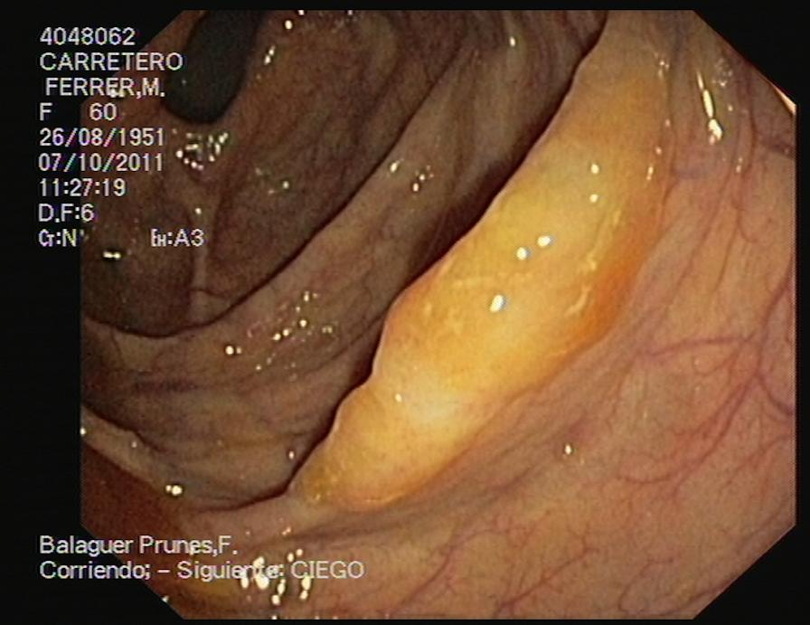 CPR 2008) CE is used to improve detection and characterization of subtle colorectal lesions Enhance