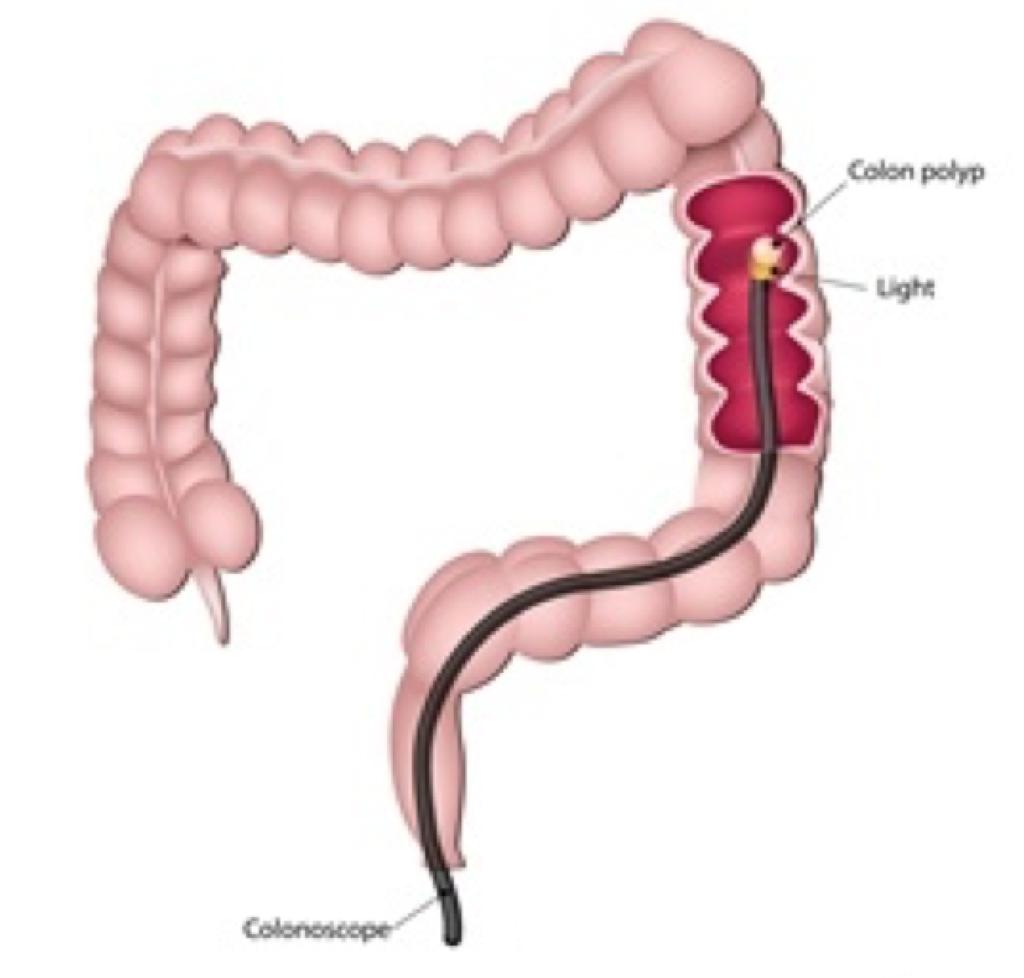 CRC prevention: colonoscopy Goals of colonoscopy: - Reduce incidence: early detection + resection (precursors) - Reduce mortality: early detection