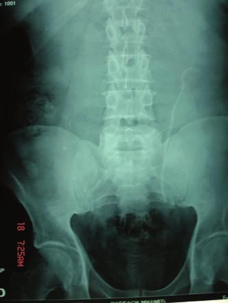 Fifteen months later, he presented with a 2-month history of right lumbar pain, hematuria, and lower urinary tract symptoms.