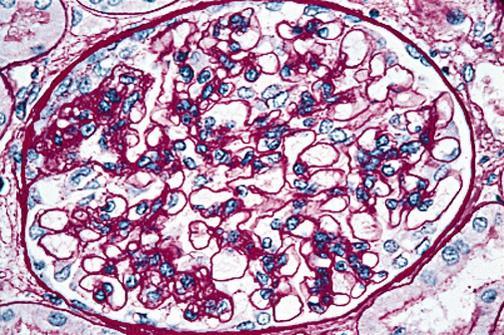 Idiopathic FSGS Is idiopathic really idiopathic? APOL1 is a major-effect risk gene for FSGS.