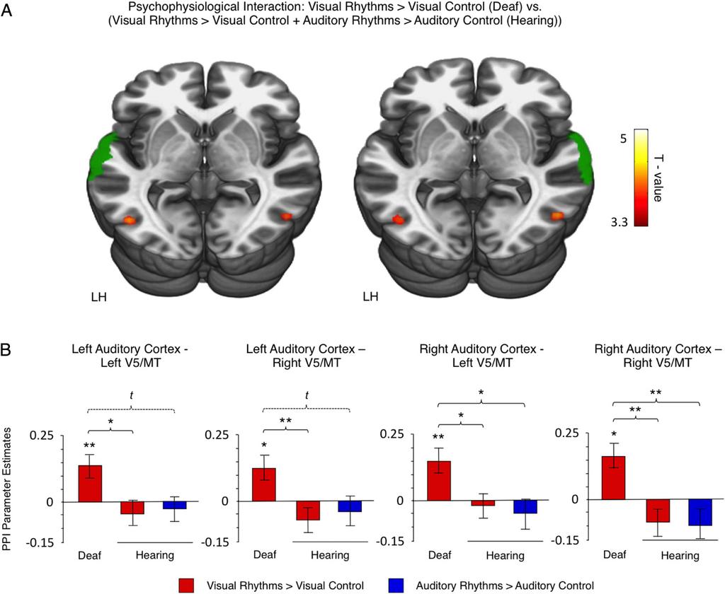 PNAS PLUS Fig. 4. Functional connectivity between the auditory cortex and the V5/MT cortex was strengthened when deaf subjects performed visual rhythm discrimination.