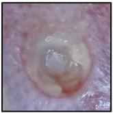 Similar observations of faster healing compared to a PHMB gauze dressing were observed in a further study