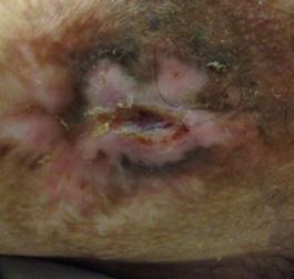 The wound showed the following signs and symptoms of clinical infection: Large amounts of purulent exudate Suspected presence of biofilm as determined by clinical opinion Discolouration of