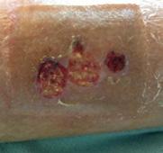 A clinical decision was made to leave the scab intact due to the presence of healthy epithelial tissue.
