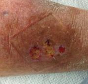 For this wound, the dressing properties most important to healing were effective debridement of slough and excellent management of wound exudate.