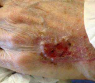 CASE 4: Traumatic wound on dorsum of the left hand Introduction A 90 year old female presented with a traumatic skin tear wound on the dorsum of her left hand.