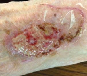 The wound showed the following signs and symptoms of clinical infection: Moderate amounts of purulent exudate Discoloured granulation tissue Pain (rated as a 2 on a visual analogue scale [VAS] during
