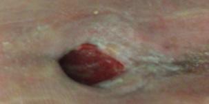 The periwound skin showed some redness.