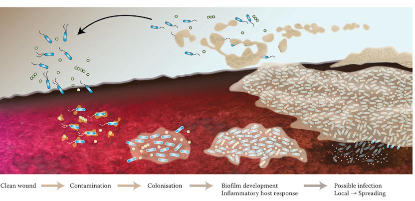 Clean wound Contamination Colonisation Biofilm development Inflammatory host response FIGURE 1: Development and maturation of biofilm in a wound Possible infection Local Spreading How does biofilm