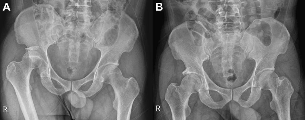 e222 M-S. PARK ET AL. Fig 1. (A) The preoperative pelvis anteroposterior view shows posterior hip dislocation.