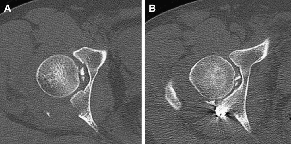 Plain radiographs confirmed the reduction of the hip as well as displaced acetabular posterior wall fractures.