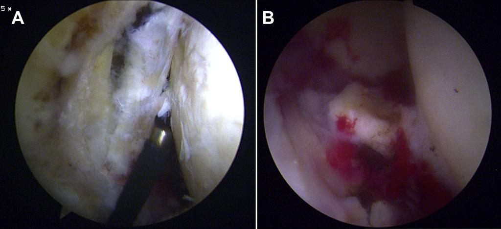 FEMORAL HEAD AND ACETABULAR FRACTURES e223 Fig 3. (A) The arthroscopic view shows the torn labrum and medial end detached from the anterior wall. (B) A large osteochondral fragment can be seen.