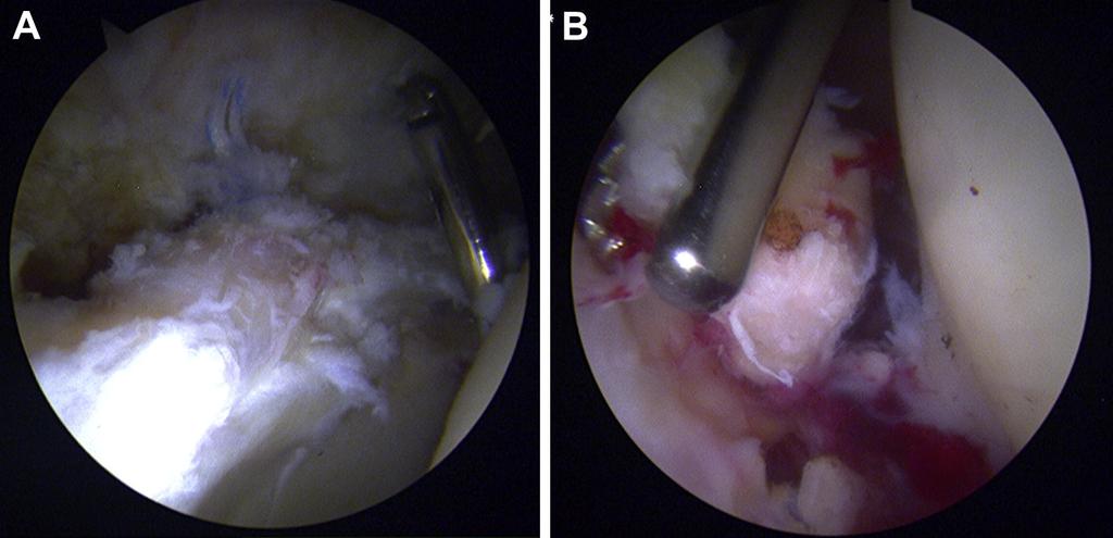 We then performed capsular closure along the longitudinal section of the T-shaped capsulotomy. The patient was allowed to take a noneweight-bearing walk with crutches 3 days after surgery.