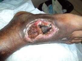 Non healing wound at