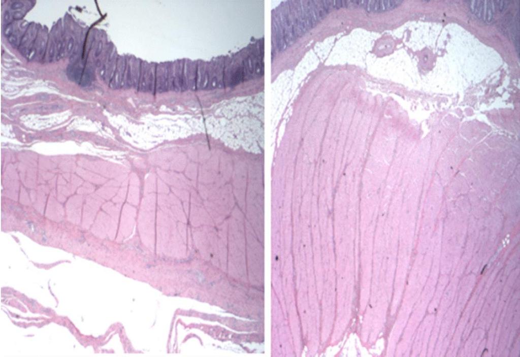 UNTREATED RF TREATMENT Herman et al, Colorectal Disease April 2015 Demonstrating a