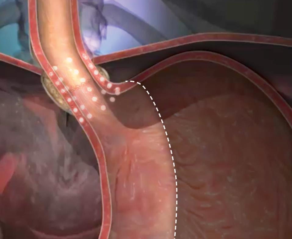 Stretta in Bariatric Patients with GERD Many patients who have had bariatric surgery have GERD post procedure. Non-surgical options for this patient population are limited...to Stretta.