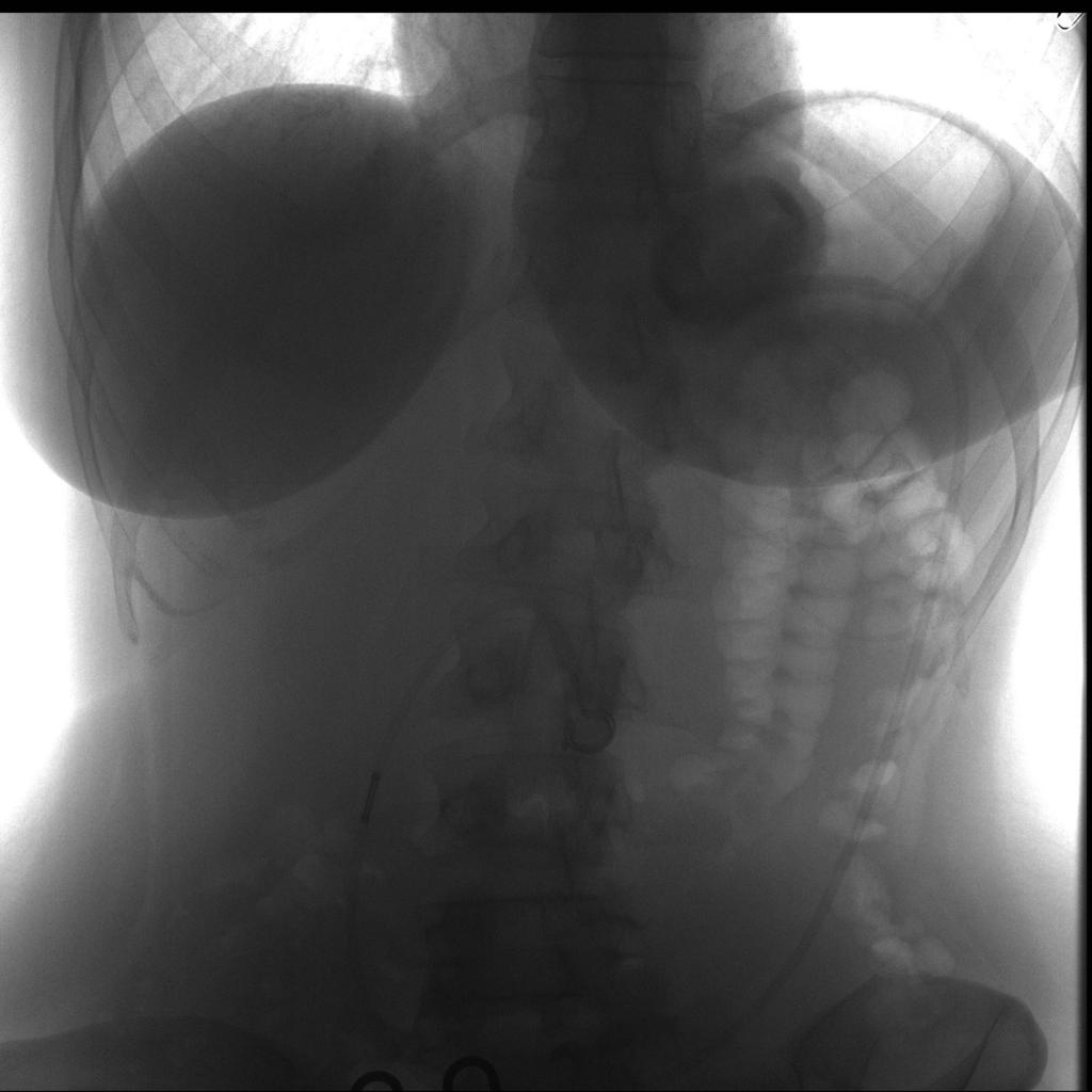 Fig. 1: Fluoroscopic image of the normal appearance of an adjustable laparoscopic gastric band in a 32-year-old female patient.