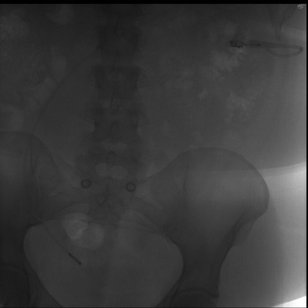 Fig. 7: Fluoroscopic image of an adjustable laparoscopic gastric band in a 25 year-old female patients
