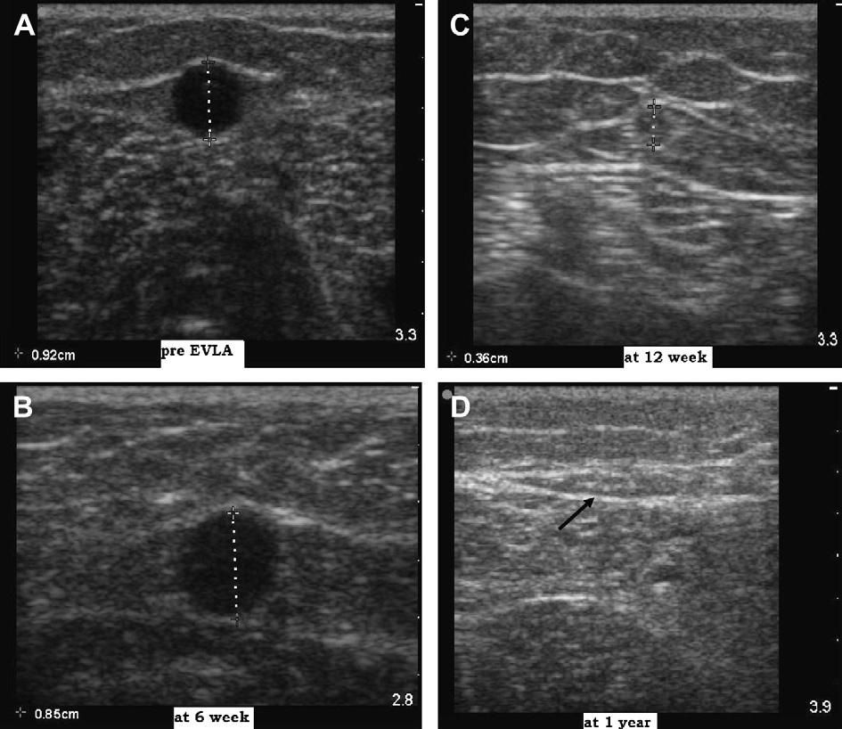 510 N.S. Theivacumar, M.J. Gough Figure 1 Sequential ultrasound appearance of GSV in a patient from the warfarin group after successful EVLA.