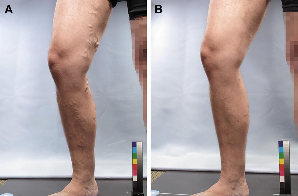 CI, Confidence interval; IPR-V 3, Independent Photography Review: Visible Varicose Veins; PA-V 3, Patient Self-assessment of Visible Varicose Veins; VVSymQ, Varicose Vein Symptoms Questionnaire.