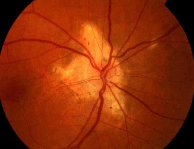 the second eye will develop choroidal neovascularization once one eye has perhaps 60-70% over a 3-year period.