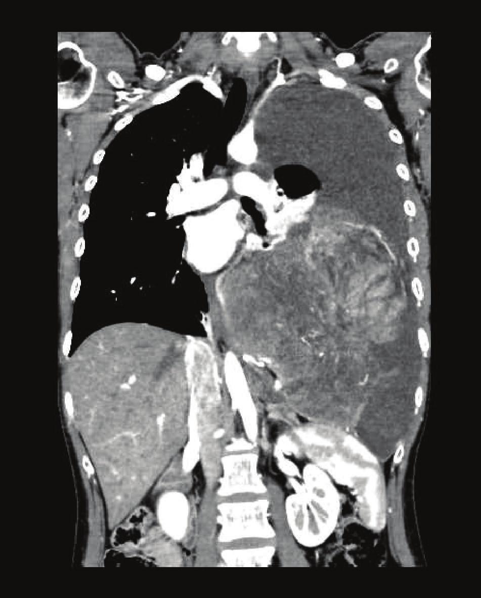 2 Case Reports in Oncological Medicine Figure 1: Chest contrast-enhanced computed tomography (CT) showing the bulky intrathoracic mass opacity on the left.