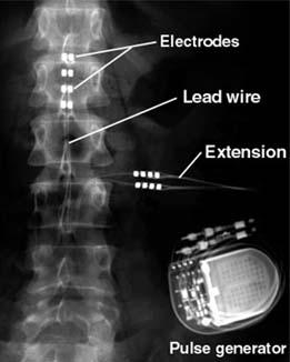 Spinal cord stimulation What causes patients to seek end-of-life?