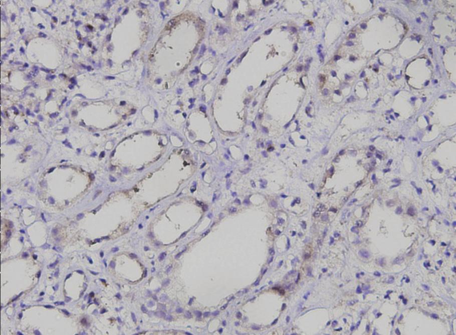 Seo MY, et al. Renal Klotho in human AKI A B C Figure 1. Immunohistochemical staining for Klotho in renal tubules in the three groups according to Klotho score.