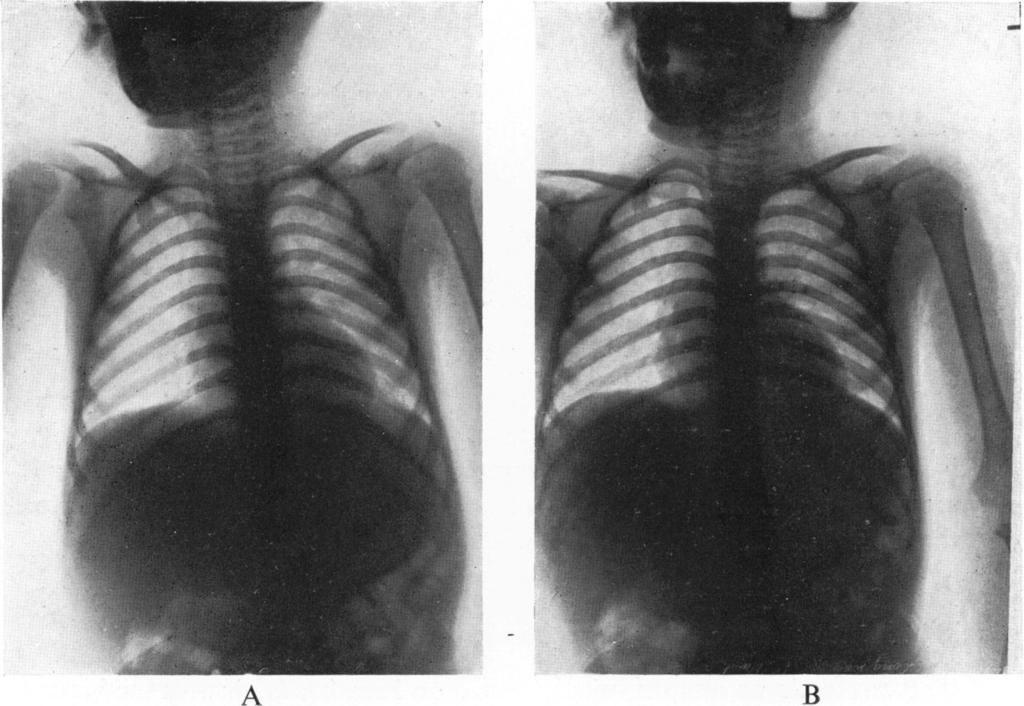 IMPORTANCE OF BRONCHOSCOPY on September 13, 1937, showed the lungs filled with air equally and the diaphragm was normal (fig. 2, A and B). A FIG. 2, A and B. (Case 1.) After bronchoscopy; lungs clear.