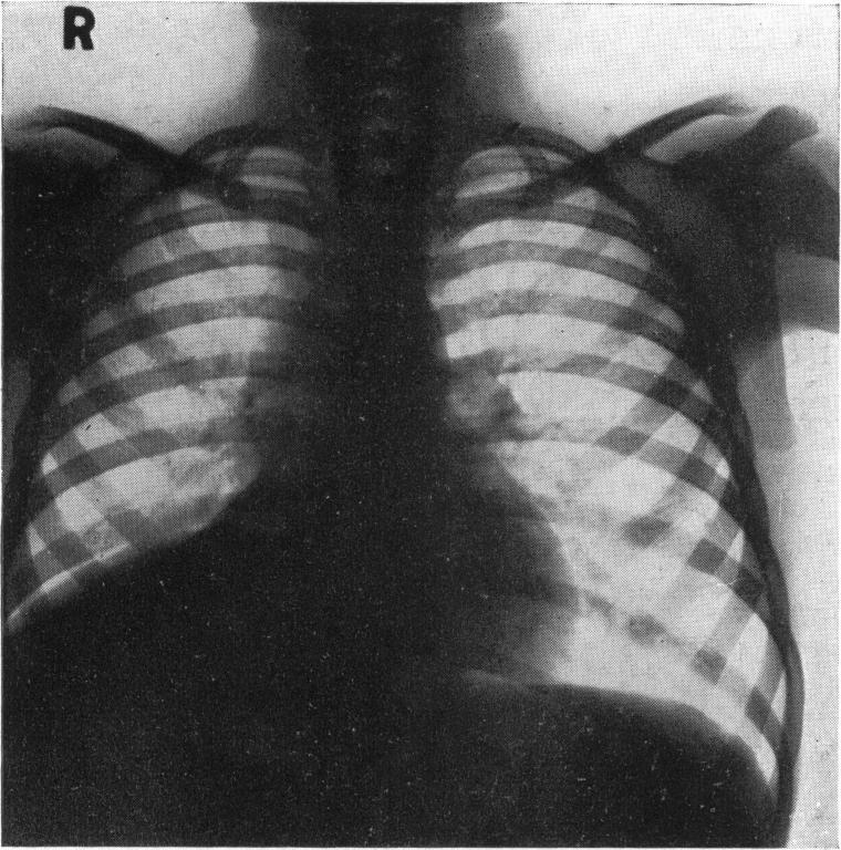 IMPORTANCE OF BRONCHOSCOPY A radiograph on January 6, 1938 (fig. 7) showed the chest clear, and as there were no abnormal physical signs he was sent home.
