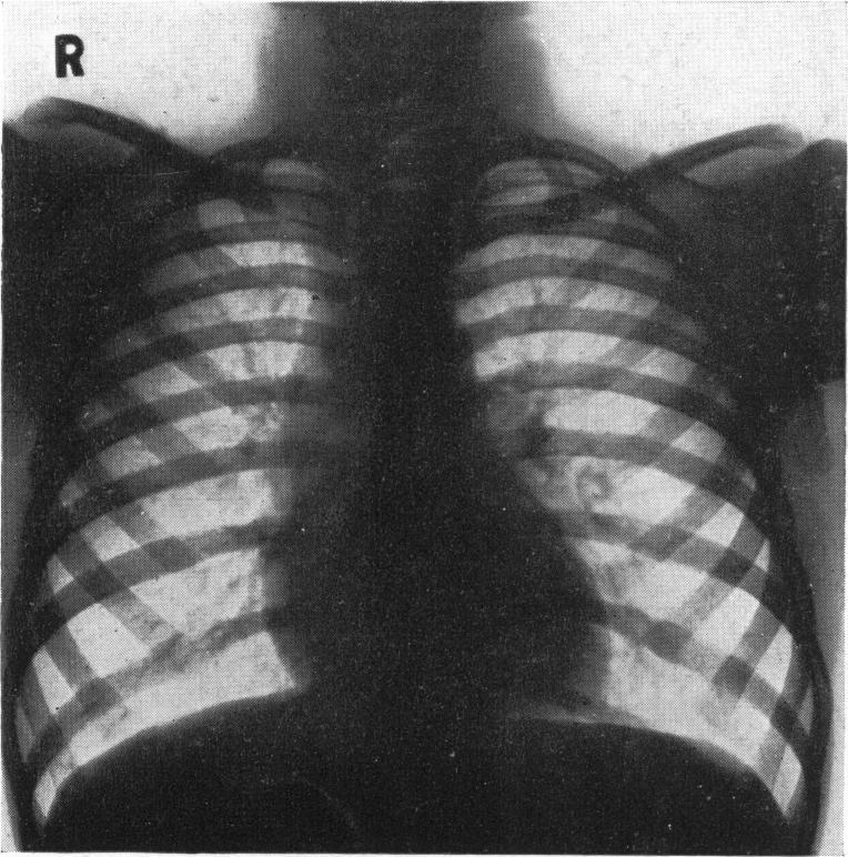 ) Before bronchoscopy, on readmission, February 21, 1938, still shows shadows due to collapse of middle and lower lobes of right lung. weeks was severe for the past week, with much sputum.