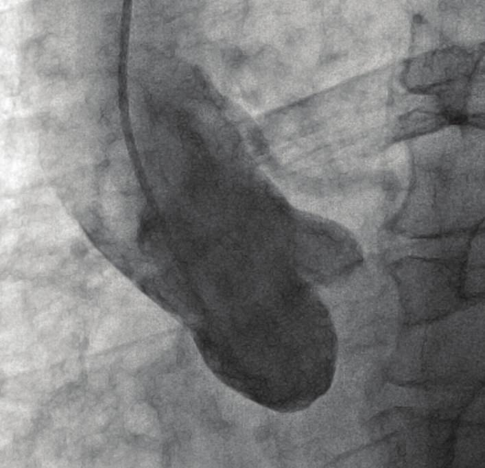 2 Case Reports in Cardiology RCA LCx LAD (a) (b) (c) Figure 1: (a) Aortography with a pigtail catheter showing the anomalous origin of the coronary artery from the ascending aorta.