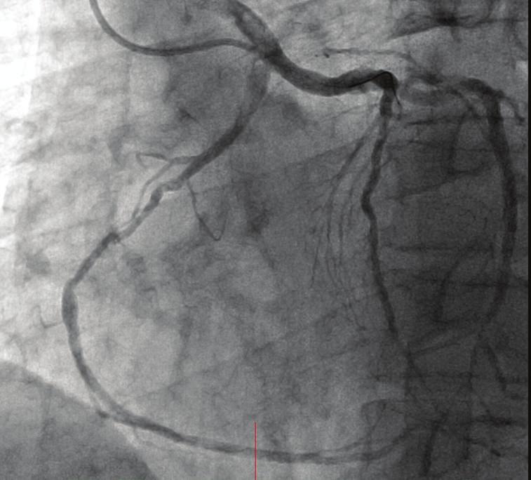 (c) Right anterior oblique view showing critical stenosis in the middle segment of the left anterior descending (LAD) artery. A 0.